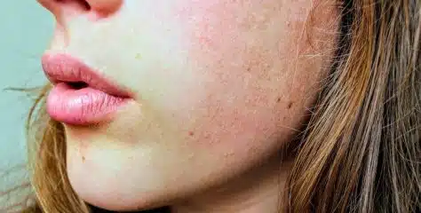 Les meilleurs conseils pour calmer les irritations et les rougeurs des peaux sensibles